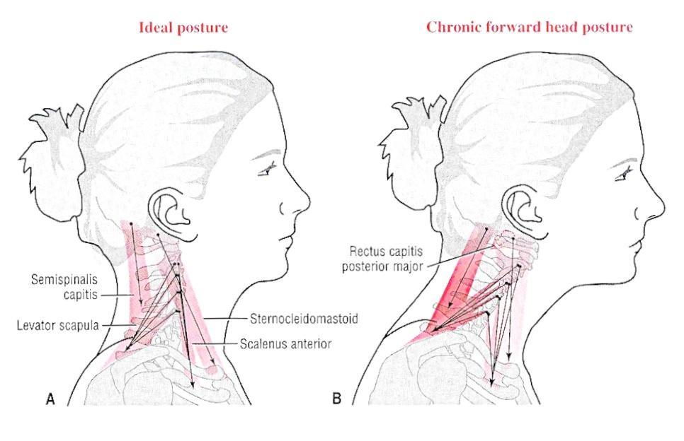 forward head posture exercises correcting