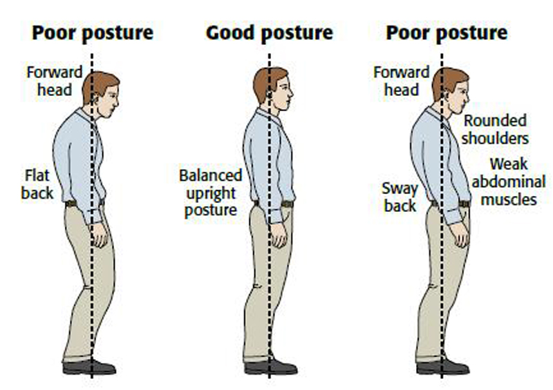 over flexed posture standing