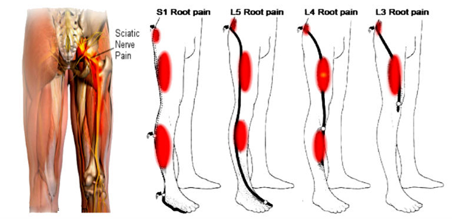 Sciatica anal burning