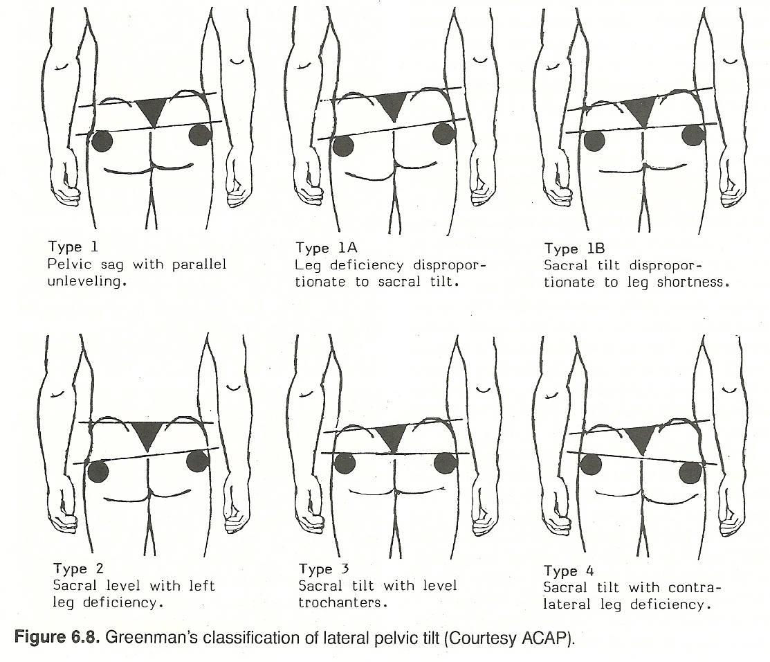 The lateral pelvic tilt : the degree of lateral pelvic tilt is