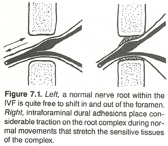 Lumbar Subluxation