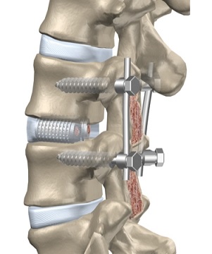A Narrative Review of Lumbar Fusion Surgery With Relevance to Chiropractic Practice