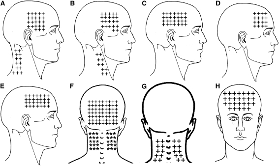 Referred Pain from Myofascial Trigger Points in Head and Neck-shoulder Muscles Reproduces Head Pain Features in Children With Chronic Tension type Headache