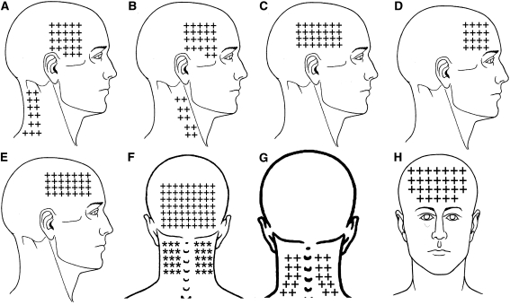 Referred Pain from Myofascial Trigger Points in Head and Neck –  Chiropractic Resource Organization – largest Chiropractic News Source