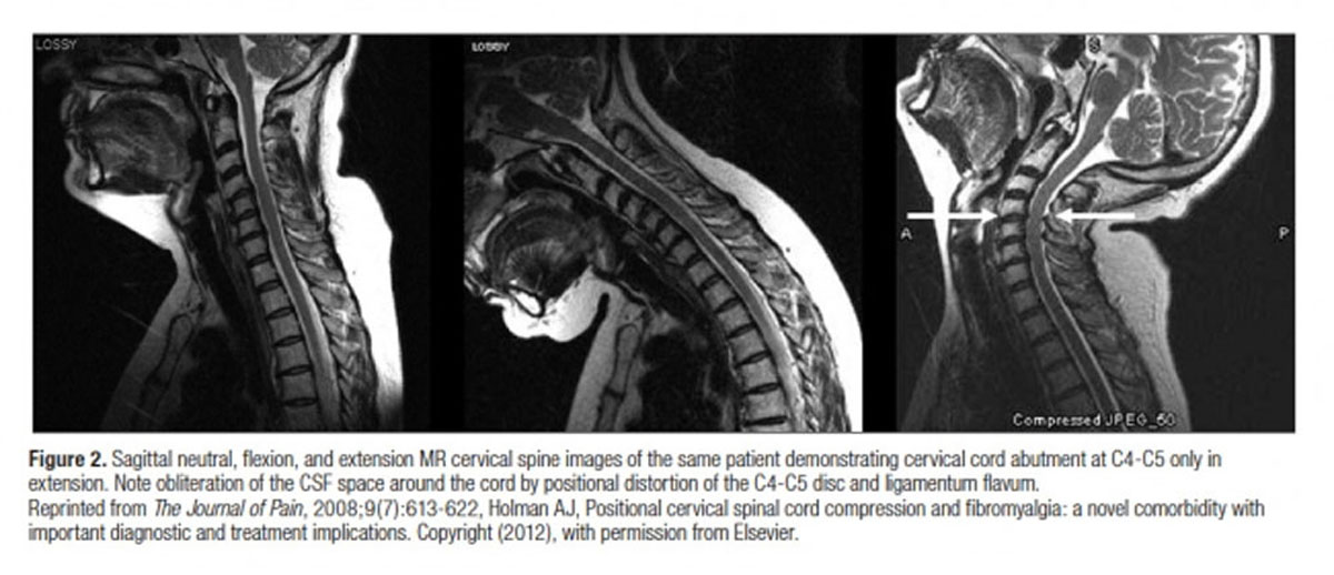 Prevalence of MRI Findings in the Cervical Spine in Patients with Persistent Neck Pain