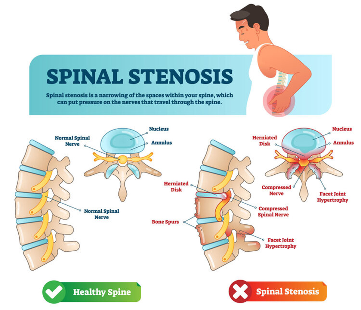 Spinal Stenosis Lumbar Region With Neurogenic Claudication Icd 10