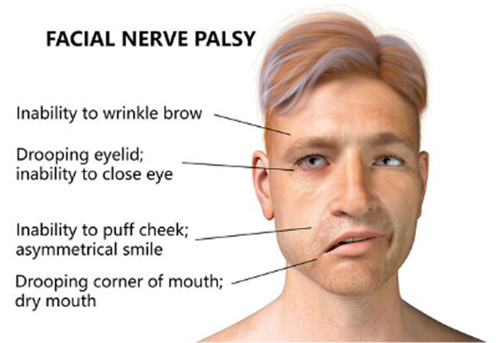Concurrent Bell’s Palsy and Facial Pain Improving with Multimodal Chiropractic Therapy: A Case Report and Literature Review