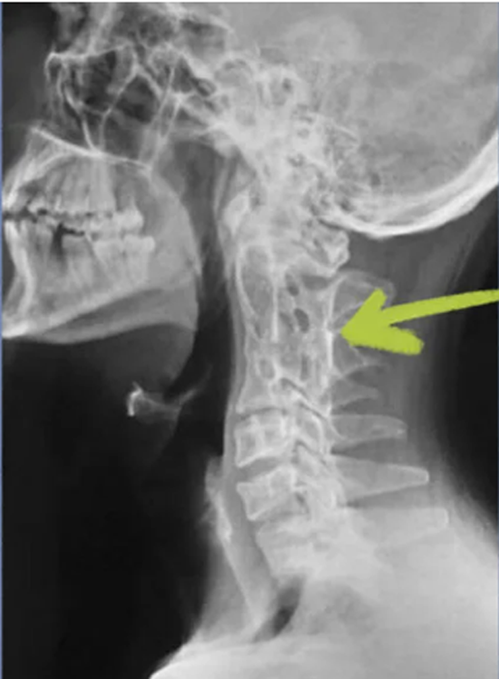 Cureus, Facial Presentation of Crohn's Disease: Report of a Case