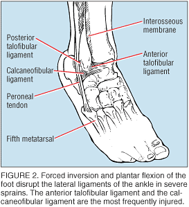 ACUTE ANKLE SPRAINS