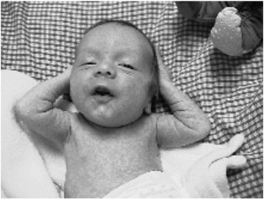 Diagnosis and Chiropractic Treatment of Infant Headache