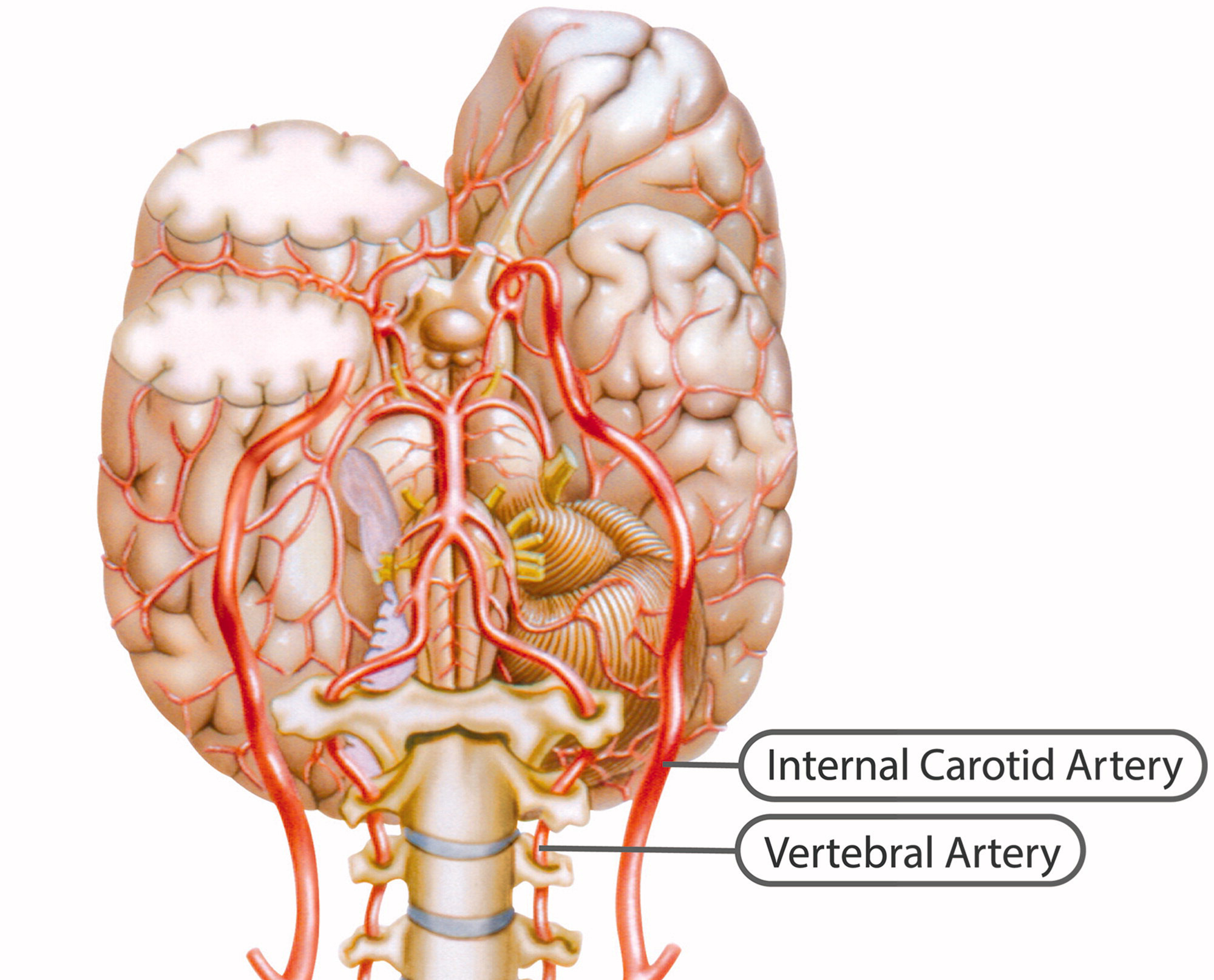 Spontaneous Cervical Artery Dissection