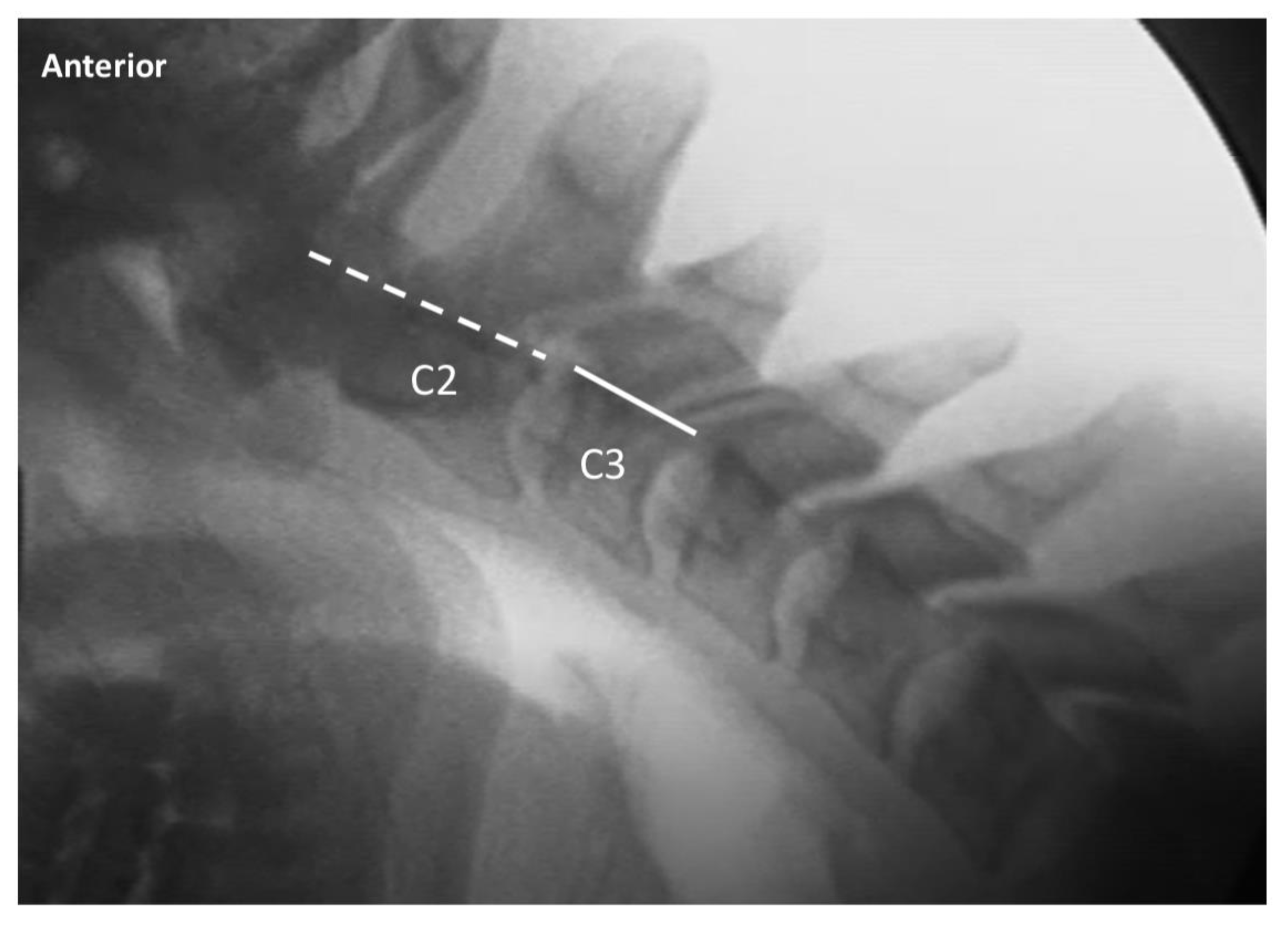 Diagnostic Accuracy of Videofluoroscopy for Symptomatic Cervical Spine Injury Following Whiplash Trauma
