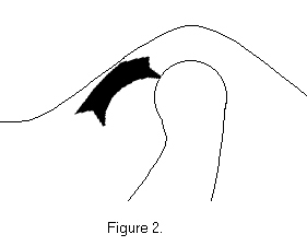 Figure 2-Anterior displacement of the disk
