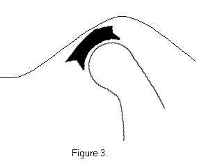 Figure 3-The disk is 'recaptured' when the mouth is opened