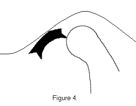 Figure 4-Anterior displacement without reduction (mouth open)